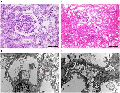 Novel mutations in ATP7B in Chinese patients with Wilson's disease and identification of kidney disorder of thinning of the glomerular basement membrane